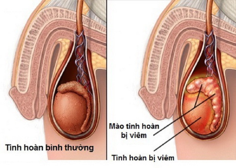 Quai bị có thể biến chứng gây viêm tinh hoàn, viêm mào tinh dẫn tới vô sinh nam