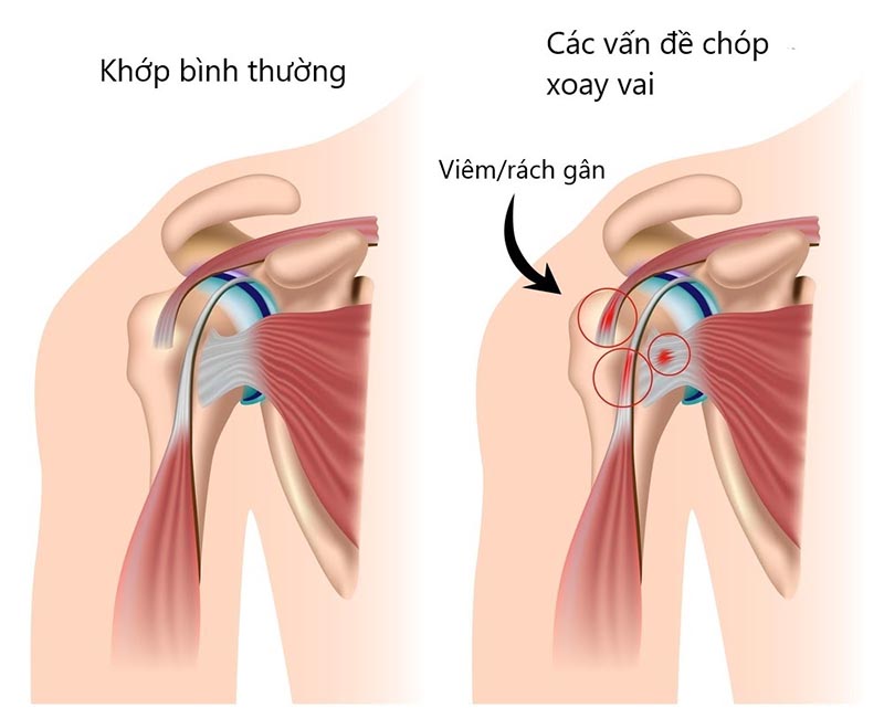 Rất nhiều tổn thương cần siêu âm khớp vai mới phát hiện được