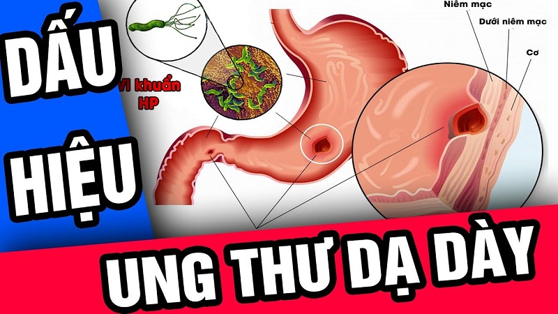 Dấu hiệu cảnh báo ung thư dạ dày