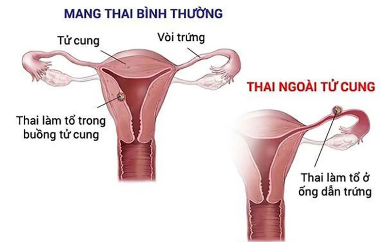 Thai ngoài tử cung gây nguy hiểm cho sức khỏe của mẹ bầu