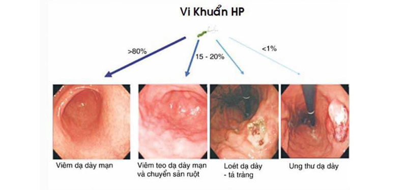 viêm dạ dày