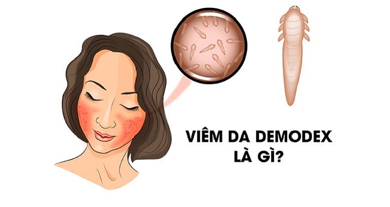 Viêm da do Demodex