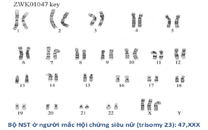 Hình ảnh 4: Bộ NST người nữ mắc hội chứng siêu nữ