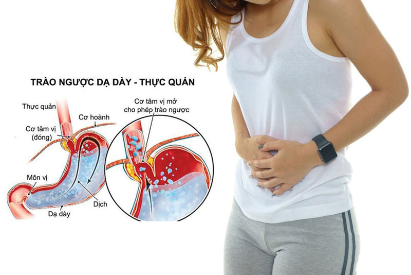 Trào ngược dạ dày do thực quản gặp vấn đề