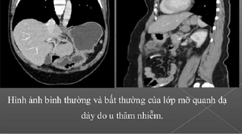 Bất thường tại dạ dày được phát hiện thông qua hình ảnh chụp cắt lớp