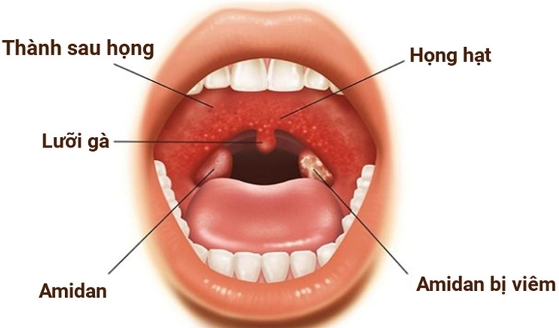 Chữa khỏi viêm họng hạt mạn tính cần xác định tác nhân