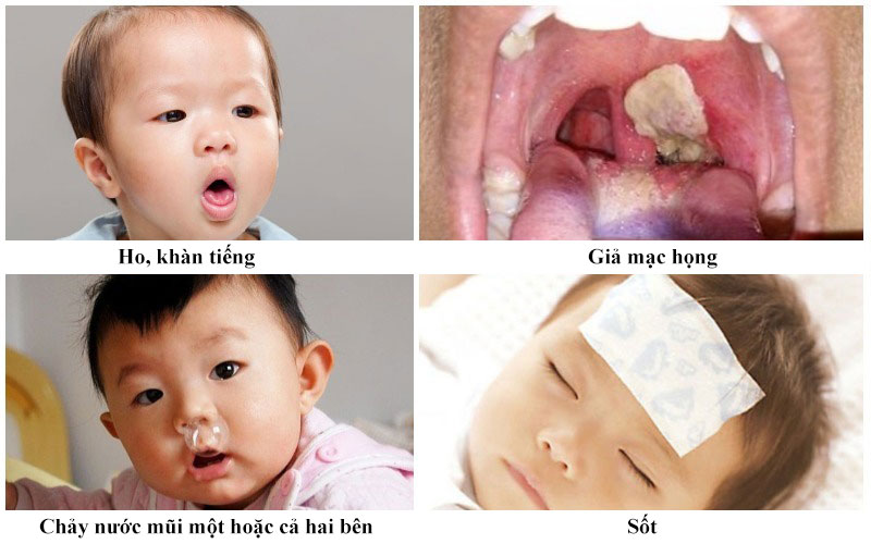 Triệu chứng lâm sàng của bệnh bạch hầu