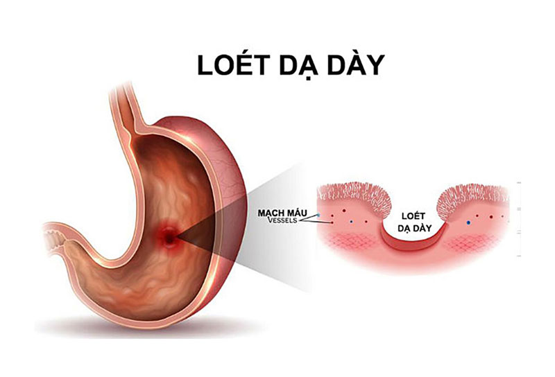 Hình ảnh minh họa bệnh loét dạ dày