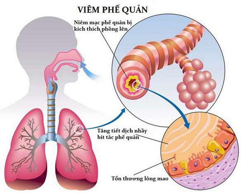 khó thở, buồn nôn