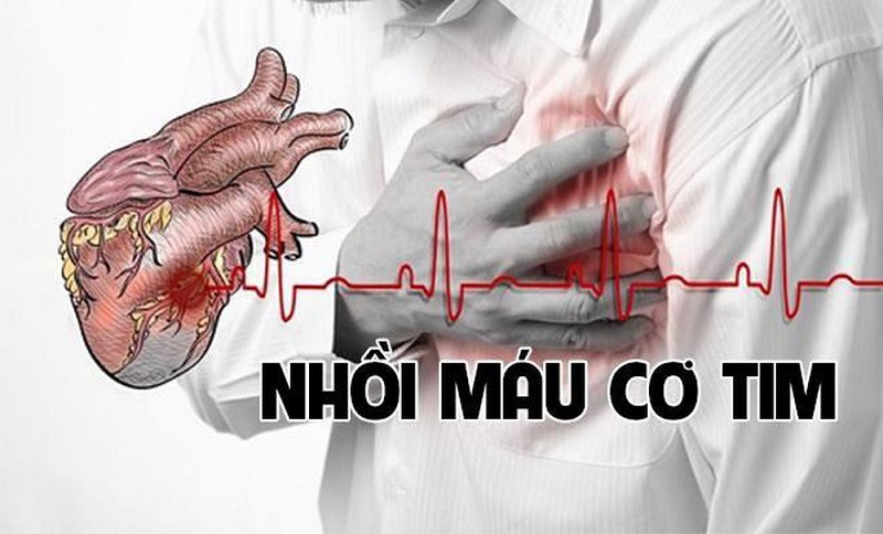 tức ngực bên trái có thể là hiện tượng nhồi máu cơ tim