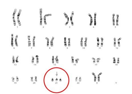 Karyotype 47,XX,+21: Người nữ mắc <a href='//www.m88bifa.info/tin-tuc/sang-loc-va-chan-doan-som-hoi-chung-down-bang-cach-nao-s195-n18614'  title ='hội chứng Down'>hội chứng Down</a>.