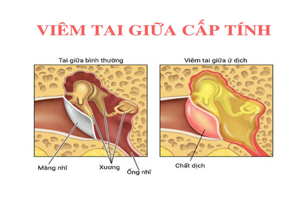 Nhiều nguyên nhân có thể dẫn tới viêm tai giữa cấp tính