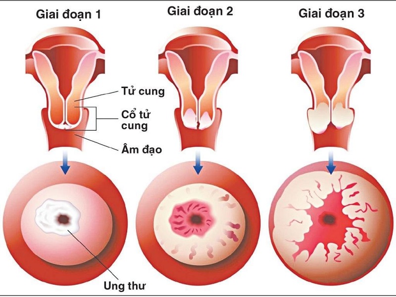 Ung thư cổ tử cung cơ hội chữa khỏi lên tới 90% khi phát hiện sớm tại MEDLATEC