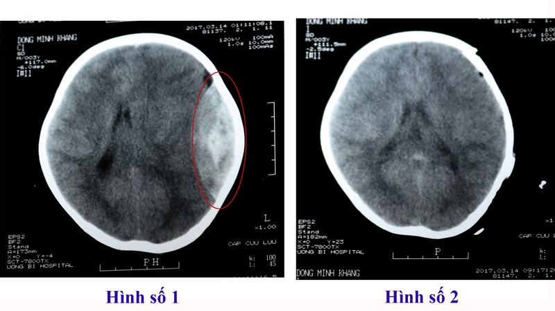  Dựng hình 3D sọ não giúp định vị vị trí tổn thương chính xác trong không gian