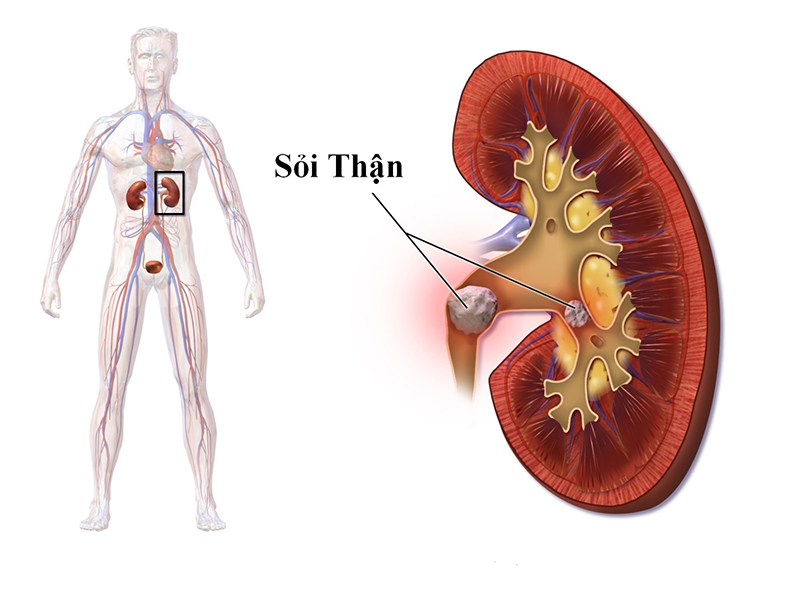 Sỏi gây chèn ép, ách tắc một số đường dẫn trong hệ tiết niệu