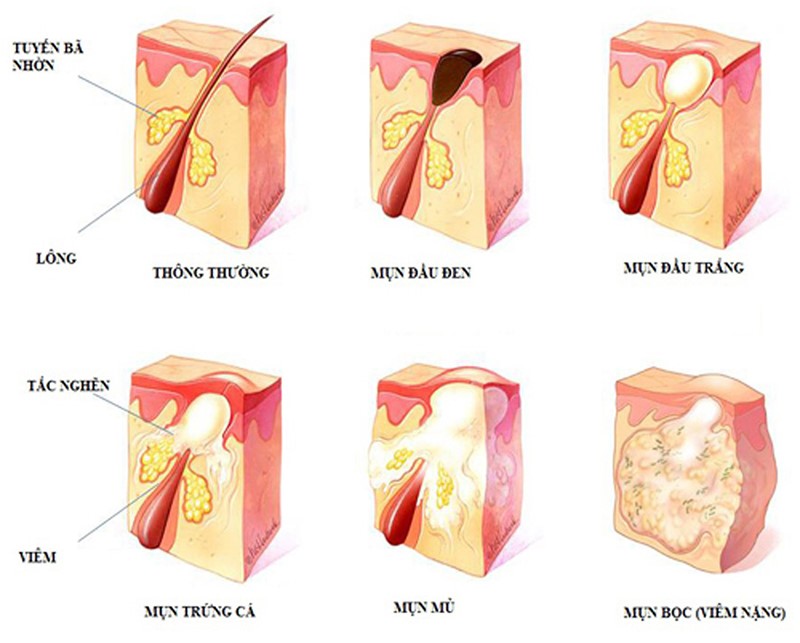 Khi mụn trứng cá chuyển sang mức độ nặng tức là tình trạng đã trở nên nặng với số lượng nhiều và biểu hiện tồi tệ hơn