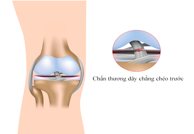 Vị trí của dây chằng chéo trước