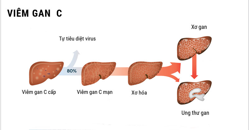 Bệnh viêm gan C có thể để lại nhiều biến chứng nghiêm trọng