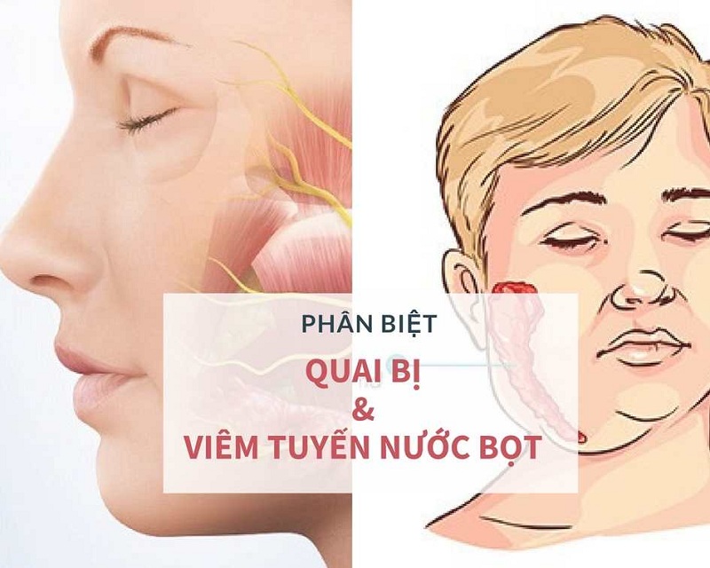 Triệu chứng quai bị dễ nhầm lẫn với viêm tuyến nước bọt nên cần phải phân biệt đúng