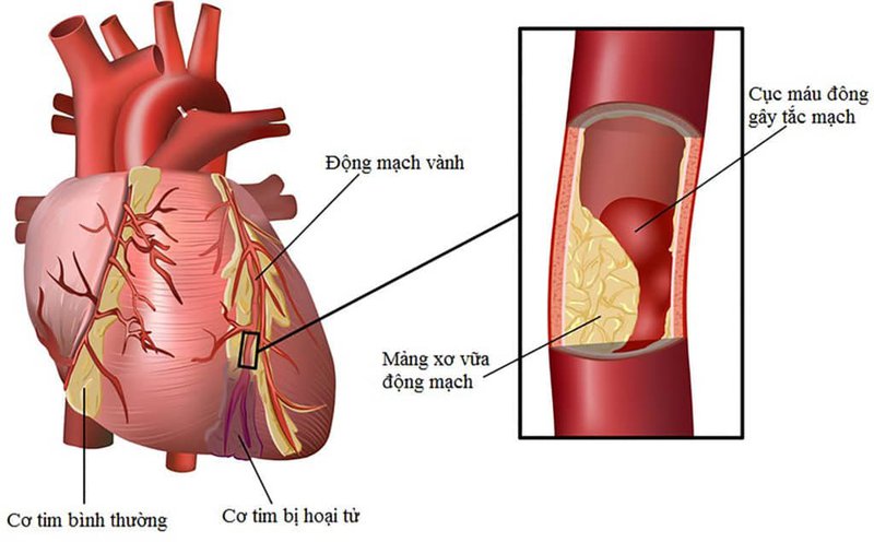 các cấp độ suy tim