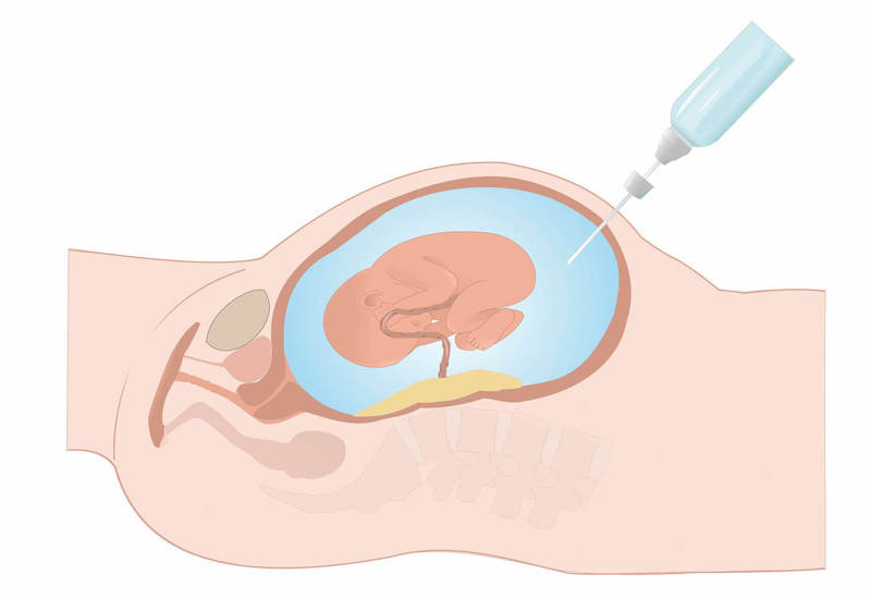 Bác sĩ sẽ dùng một cây kim nhỏ hút một lượng nước ối đủ để chẩn đoán