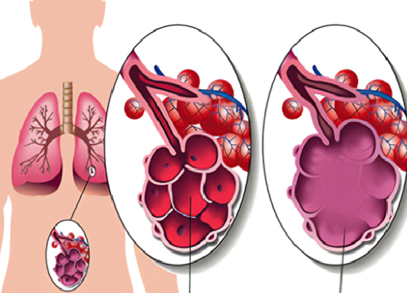Bệnh giãn phế nang