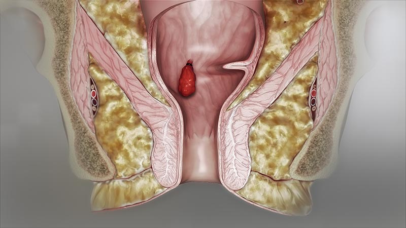 Tùy từng trường hợp và mức độ bệnh lý mà chi phí phẫu thuật trĩ sẽ khác nhau