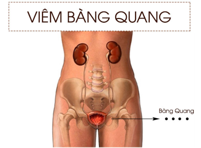 Viêm bàng quang là một loại nhiễm trùng đường tiết niệu.