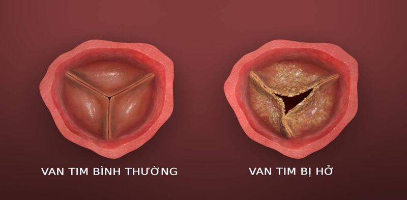 Siêu âm tim giúp kiểm tra tình trạng van tim và hoạt động của nó