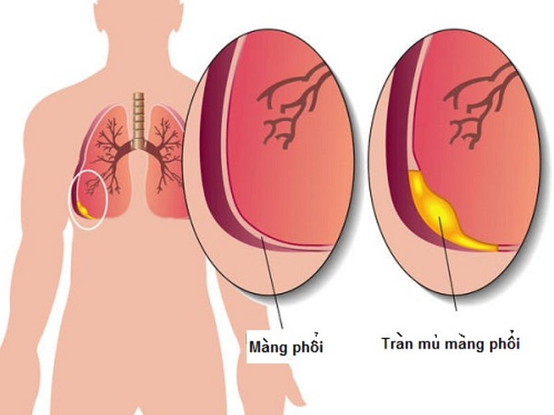 Tràn mủ màng phổi