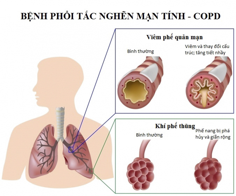 Bệnh phổi tắc nghẽn mạn tính là nguyên nhân gây tử vong xếp hàng thứ 3 trong các nguyên nhân gây tử vong toàn cầu