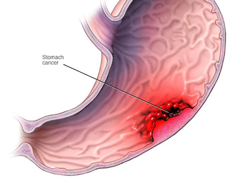 Hình ảnh minh hoạ dạ dày tổn thương