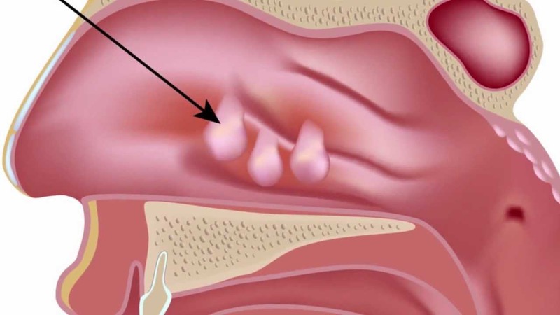 Polyp mũi là những khối u lành tính không phải ung thư