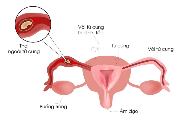 Hình ảnh chửa ngoài tử cung