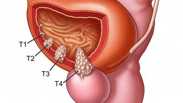 Ung thư tuyến tiền liệt