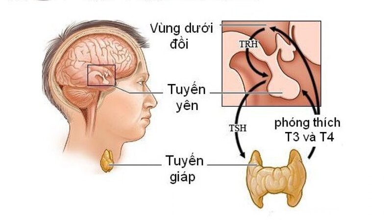 U tuyến yên gây vô sinh