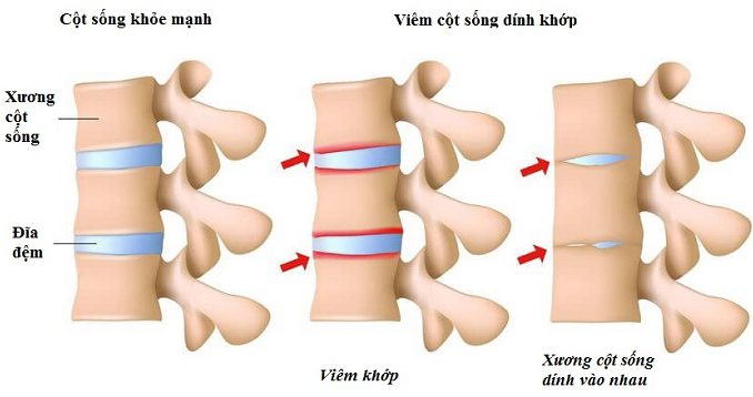 Viêm cột sống dính khớp (AS) là một bệnh viêm khớp mãn tính ở cột sống