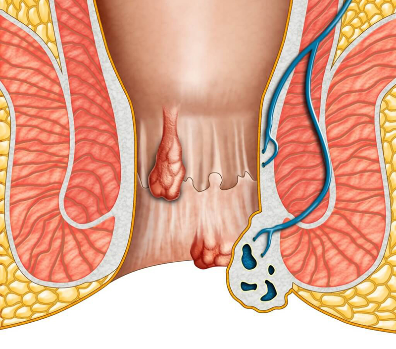 sau cắt trĩ cần lưu ý điều gì