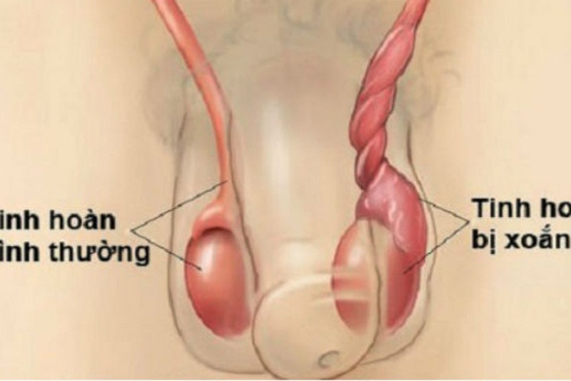 xoắn tinh hoàn ở trẻ nhỏ