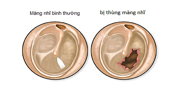 Thủng màng nhĩ