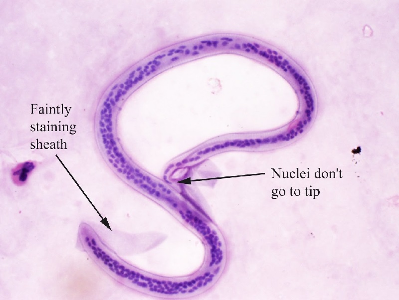 Bệnh giun chỉ (Onchocerciasis) do loài giun Onchocerca volvulus gây bệnh