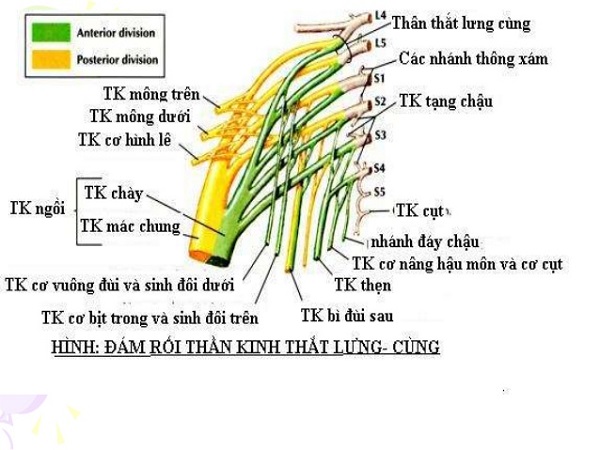 Bệnh đám rối thần kinh thắt lưng là tình trạng tổn thương đám rối thắt lưng