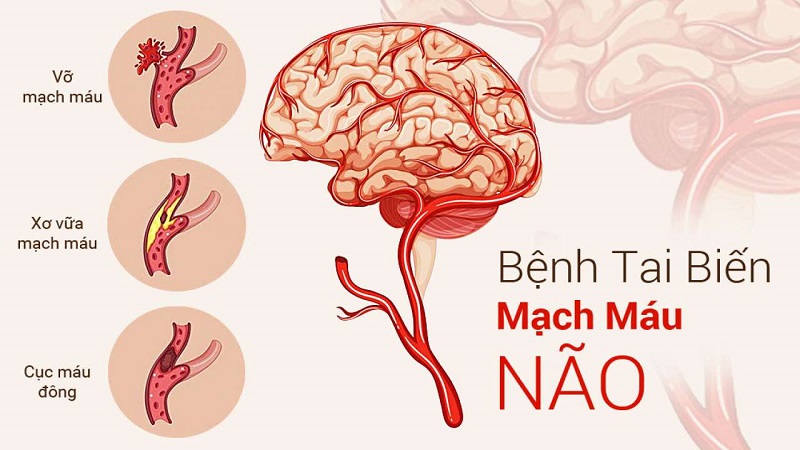 Tai biến mạch máu não