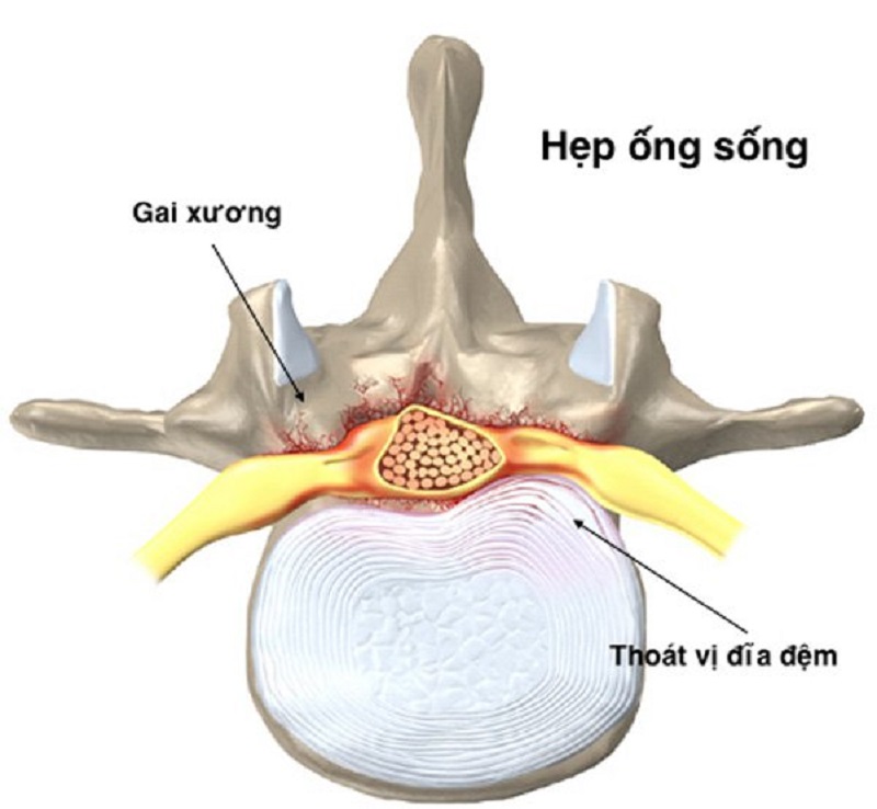 Hình ảnh mô tả hẹp ống sống