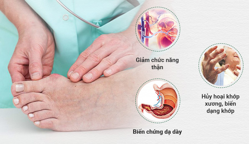 Những biến chứng cho thấy bệnh giả Gout nguy hiểm không