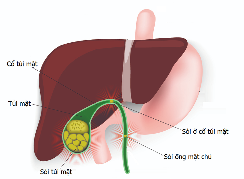 Sỏi túi mật là bệnh lý phổ biến ở Việt Nam