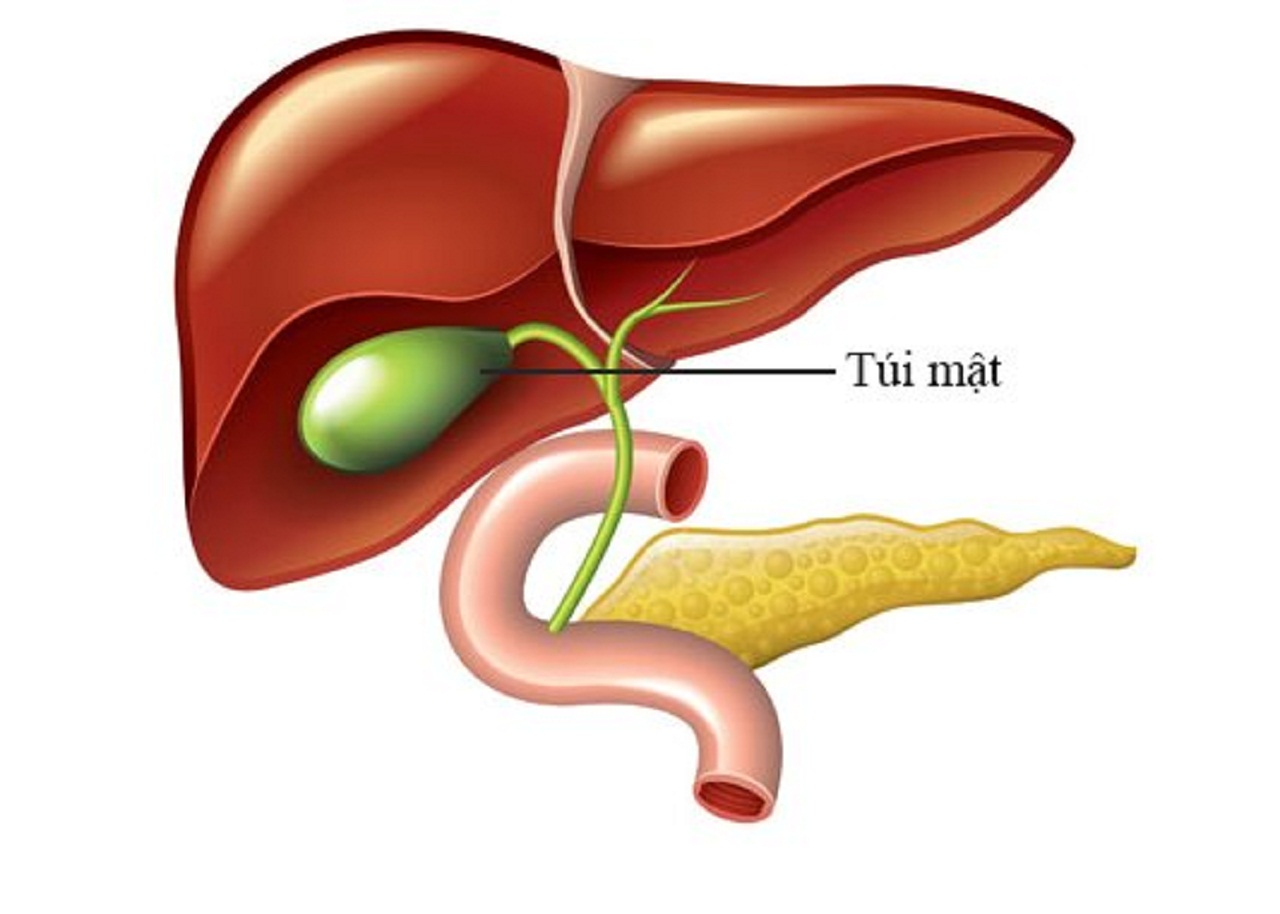 Polyp túi mật là sự phát triển quá mức của niêm mạc thành túi mật