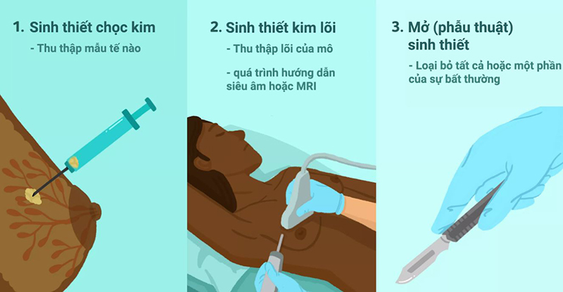 Sinh thiết hút chân không đem lại hiệu quả cao hơn các phương pháp sinh thiết trước đó