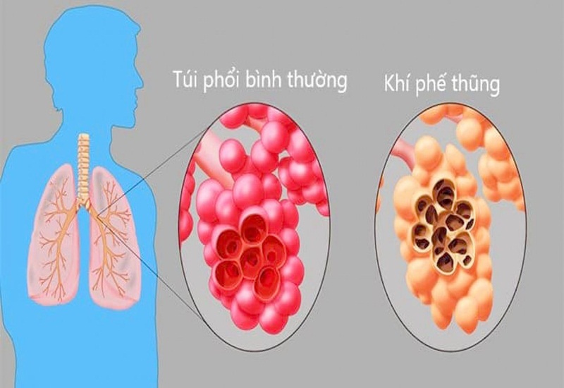 Bệnh giãn phế nang còn được gọi là khí phế thũng