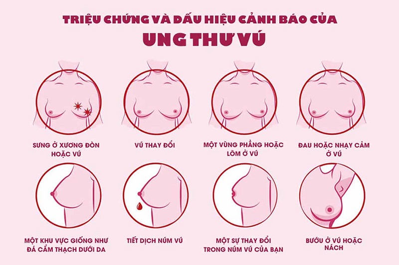 Những dấu hiệu cảnh báo bệnh ung thư vú